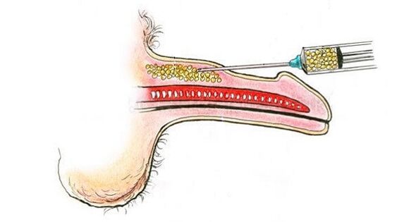 Hyaluronic acid injections in a member's cannon to increase it